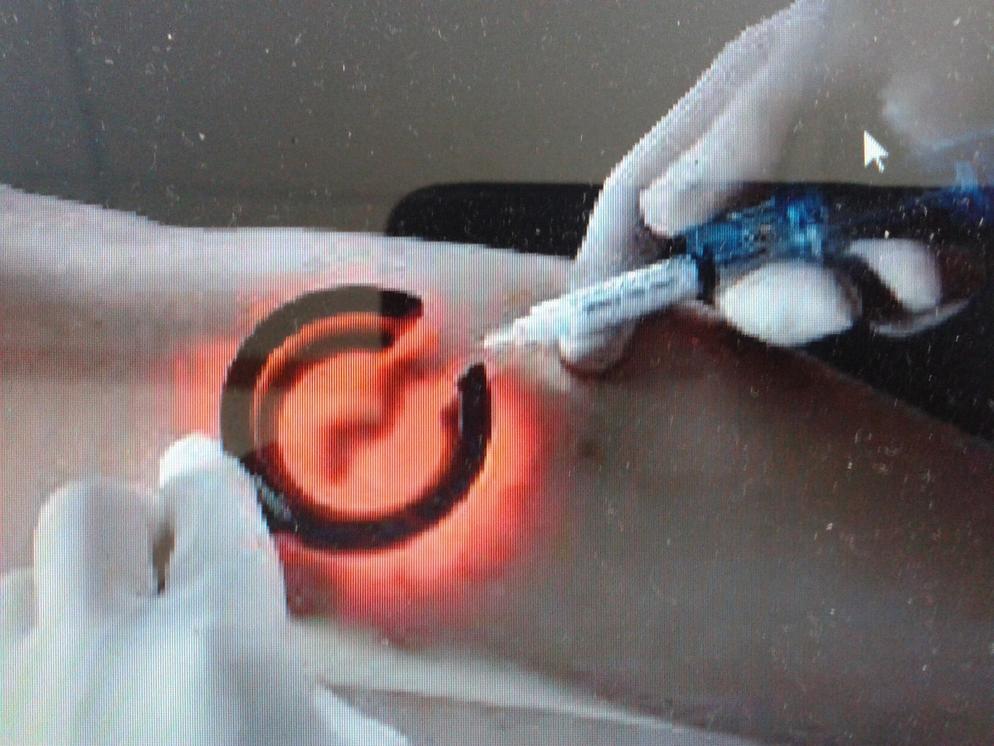 Medical Vein Finder
