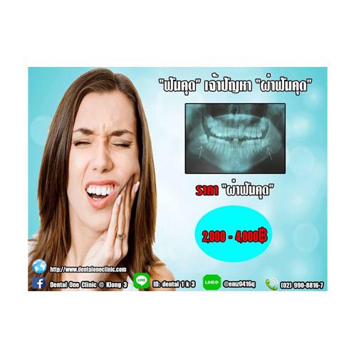 ฟันคุด